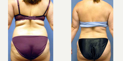 Liposuction before and after photo
