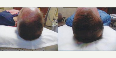 PRP for Hair Loss before and after photo