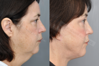 Eyelid Surgery before and after photo