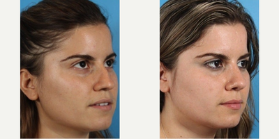 Revision Rhinoplasty before and after photo