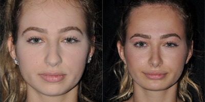 Rhinoplasty before and after photo