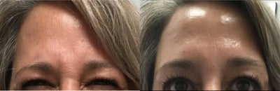 Dysport before and after photo