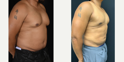 Gynecomastia Surgery before and after photo