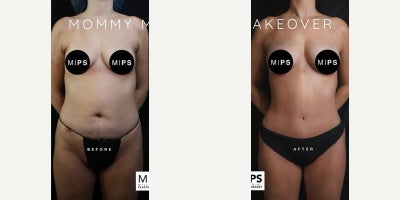 Tummy Tuck before and after photo