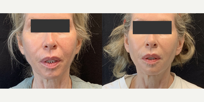 Voluma before and after photo