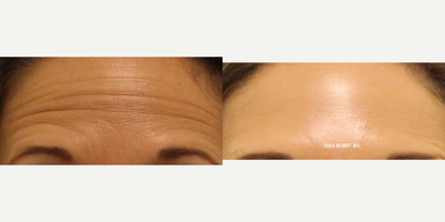 Botox before and after photo