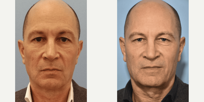 Botox before and after photo