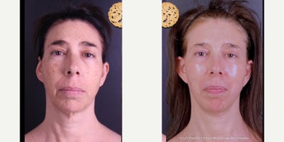 Facelift before and after photo