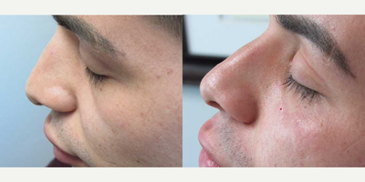 Juvederm before and after photo