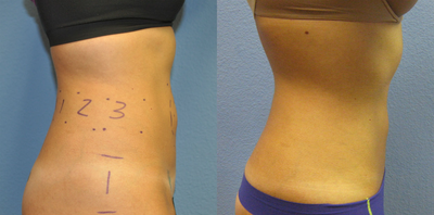 Liposonix before and after photo