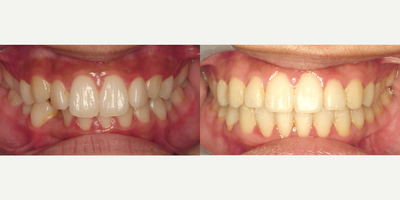 Braces before and after photo