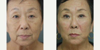 CO2 Laser before and after photo
