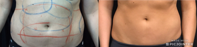 CoolSculpting before and after photo