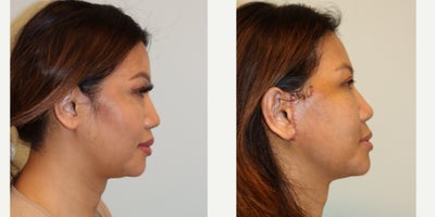 before and after image