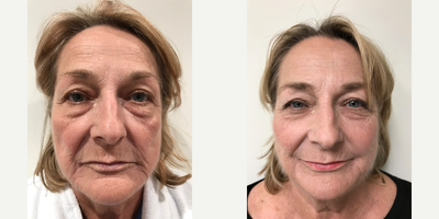 Dermal Fillers before and after photo