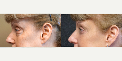 Eyelid Surgery before and after photo