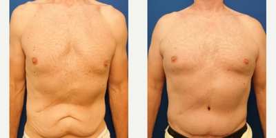Tummy Tuck before and after photo