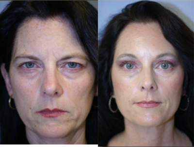 Brow Lift before and after photo