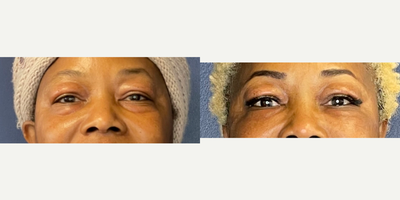 Eyelid Surgery before and after photo
