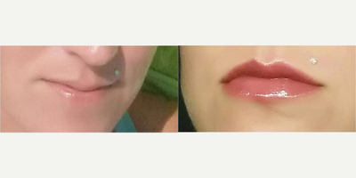 Lip Fillers before and after photo