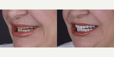 Lumineers before and after photo