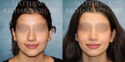 Rhinoplasty before and after photo