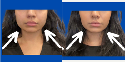 Botox for TMJ before and after photo