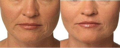 Juvederm before and after photo