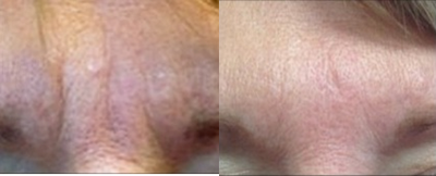 Restylane before and after photo