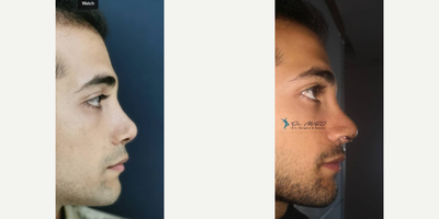 Revision Rhinoplasty before and after photo