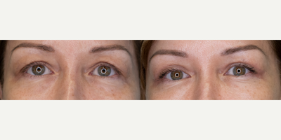 Eyelid Surgery before and after photo