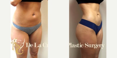 Liposuction before and after photo