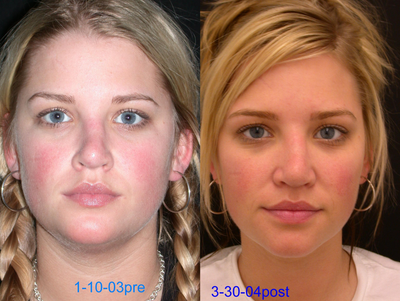 Rhinoplasty before and after photo
