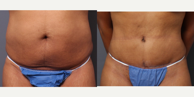 Tummy Tuck before and after photo