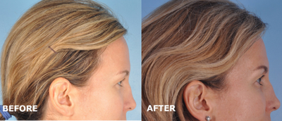 Eyelid Surgery before and after photo