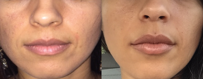 Juvederm before and after photo