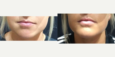 Juvederm before and after photo