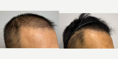 PRP for Hair Loss before and after photo