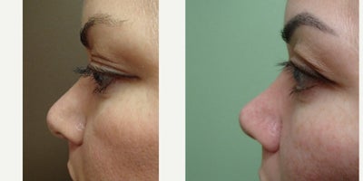 Rhinoplasty before and after photo