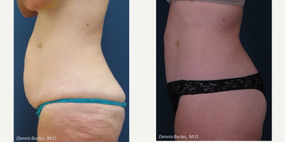 Tummy Tuck before and after photo