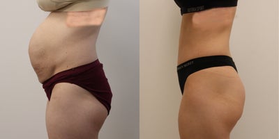 Tummy Tuck before and after photo