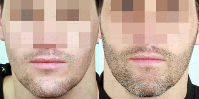 Beard Transplant before and after photo
