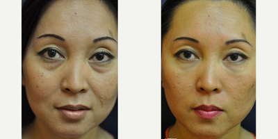 Belotero before and after photo
