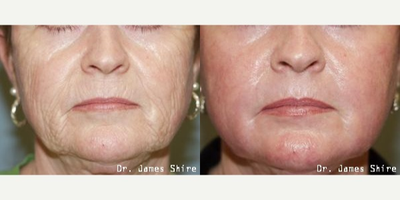 Chemical Peel before and after photo