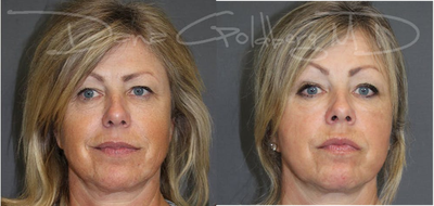 CO2 Laser before and after photo