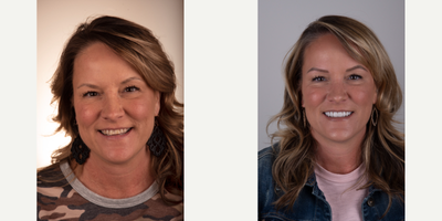 Full Mouth Reconstruction before and after photo