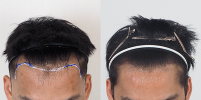 Hair Transplant before and after photo