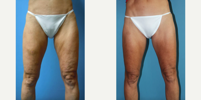 Liposuction before and after photo