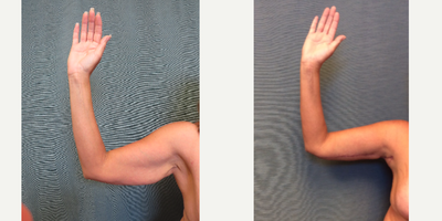 Arm Lift before and after photo
