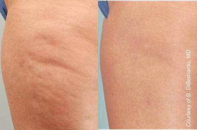 Cellulaze before and after photo